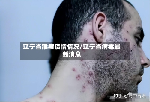 辽宁省猴痘疫情情况/辽宁省病毒最新消息-第2张图片