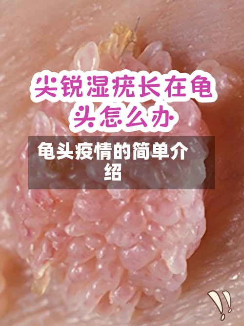 龟头疫情的简单介绍-第2张图片