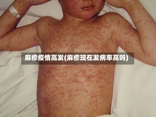 麻疹疫情高发(麻疹现在发病率高吗)-第2张图片